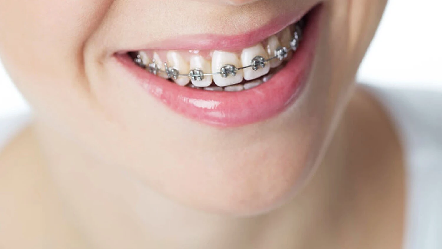 Dlaczego powinienem leczyć się ortodontycznie.jpg