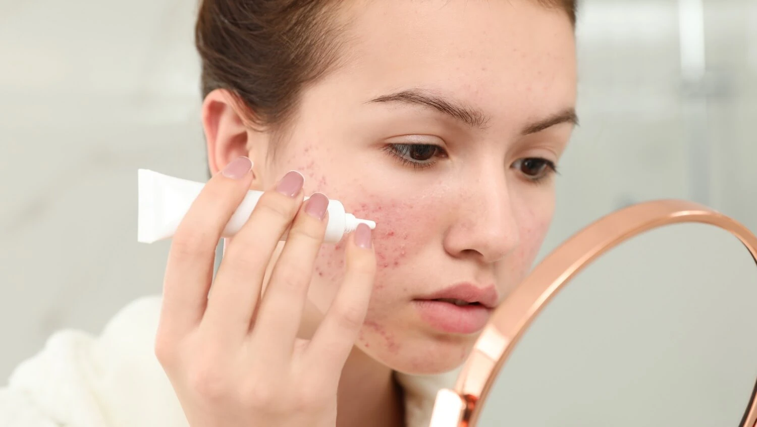 Trądzik różowaty.jpg