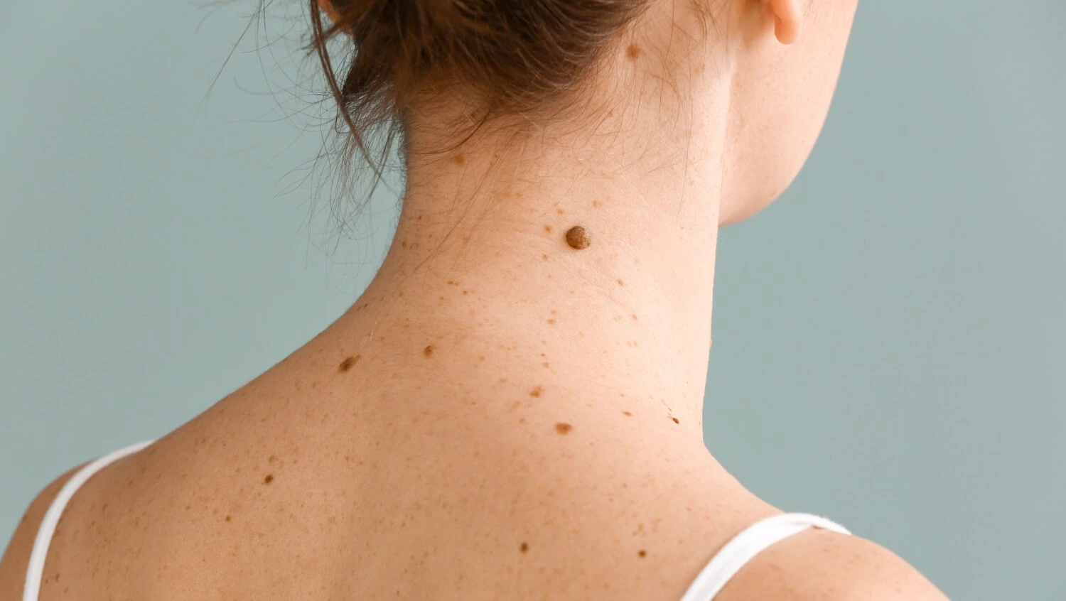 laserowe usuwanie znamion