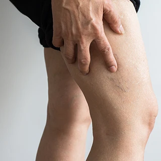 Leczenie żylaków metodą ClosureFas