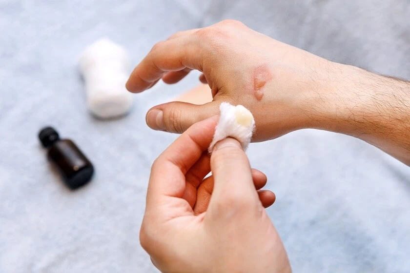 Dłoń z bąblem spowodowanym oparzeniem