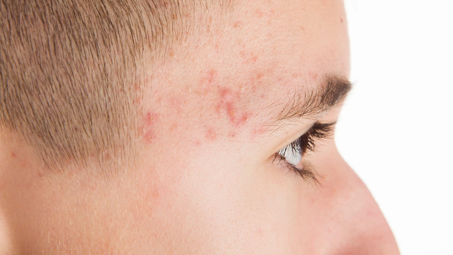 Trądzik – czym jest i skąd się bierze?